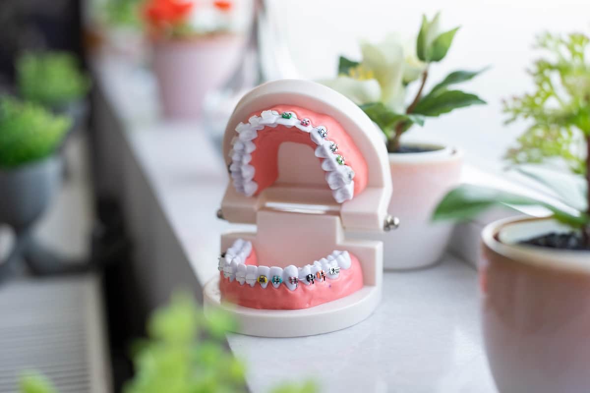 braces on teeth
